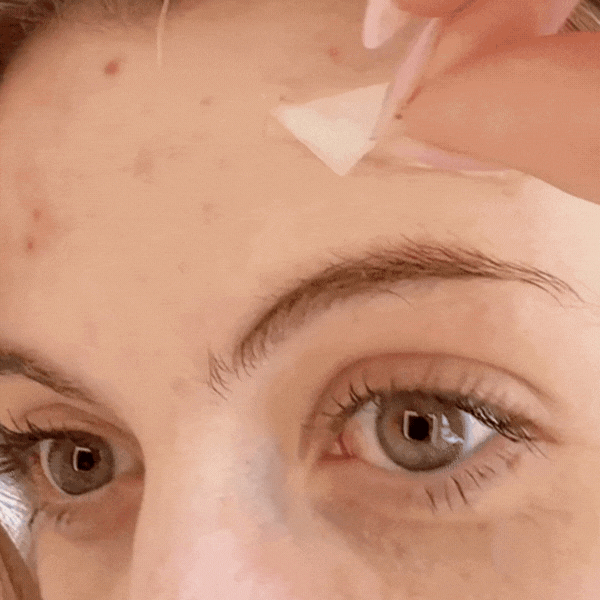 Hydrocolloid Treatment