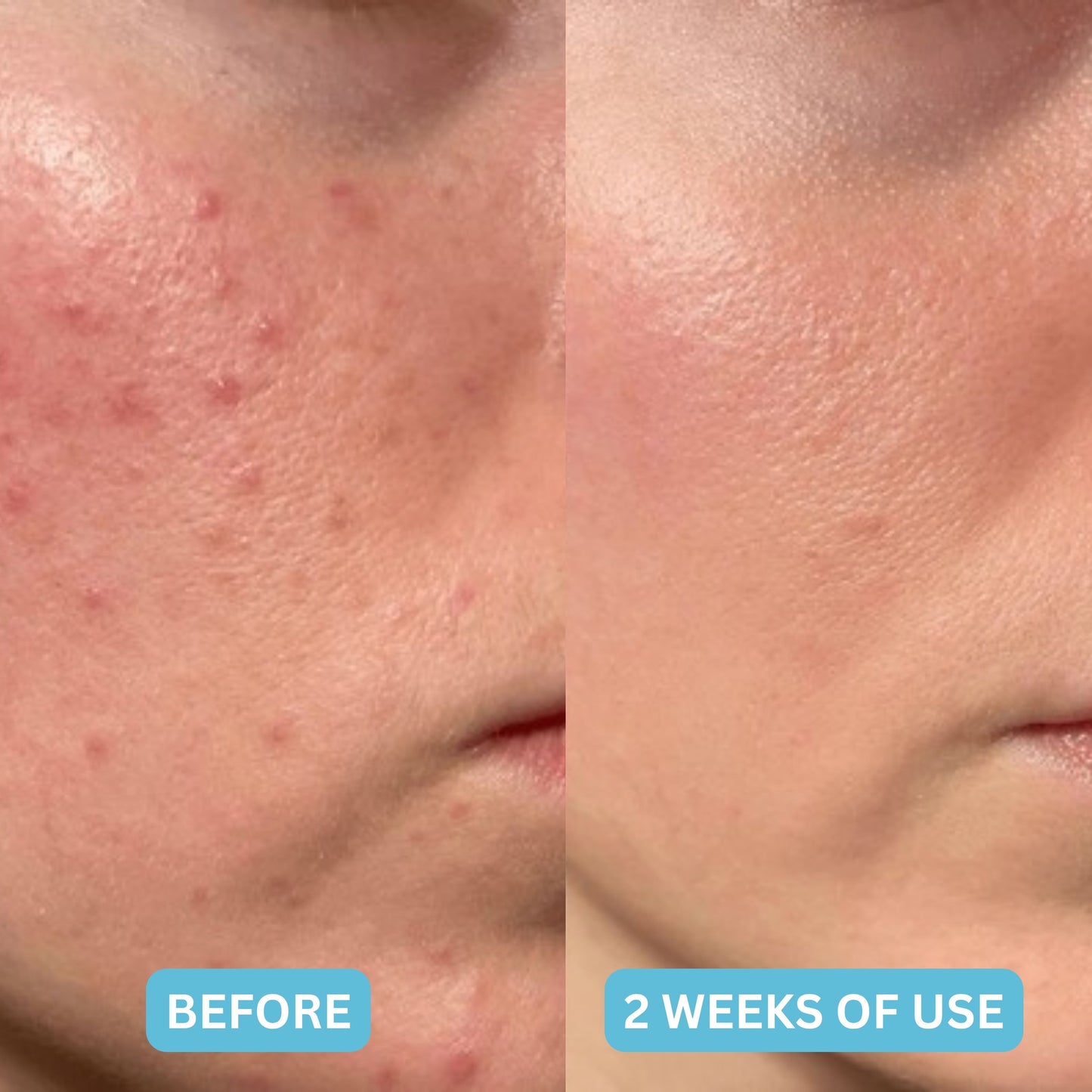 Hydrocolloid Treatment