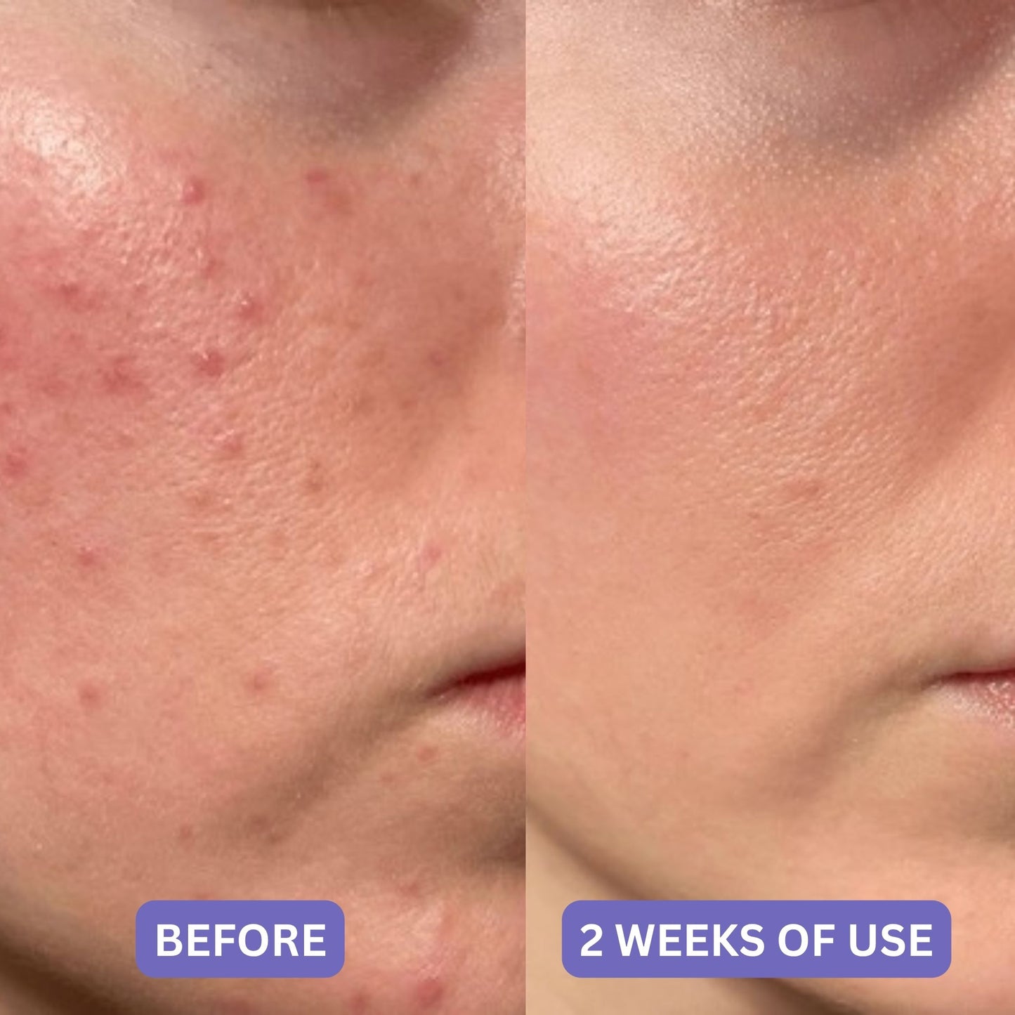 Hydrocolloid Treatment